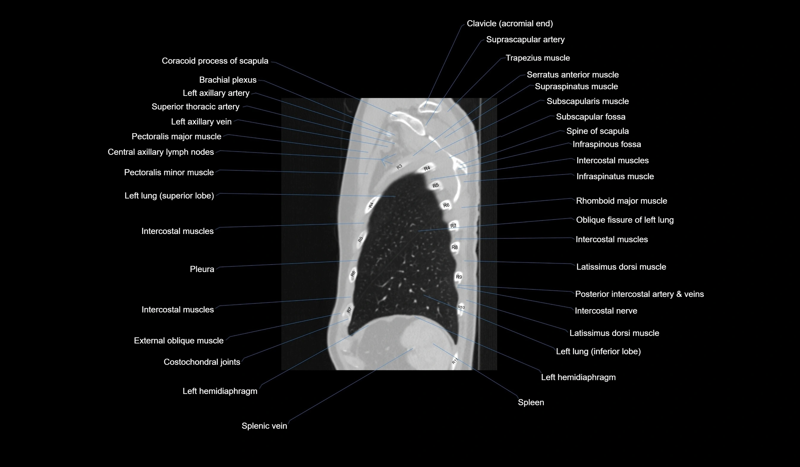CT chest (thorax) labelled sagittal cross sectional anatomy radiology image-00122.webp